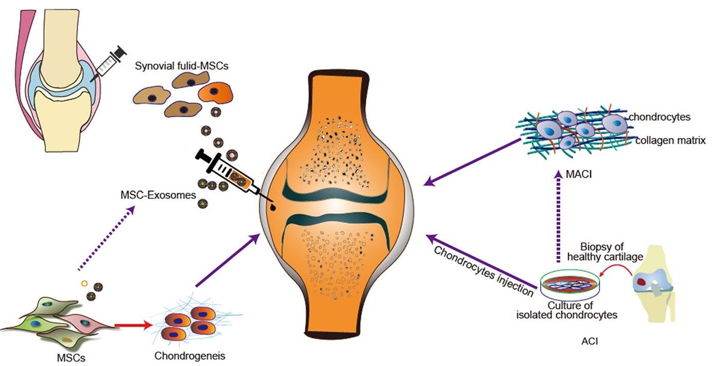Fig.1 Osteoarthritis cell and cell-free therapies.